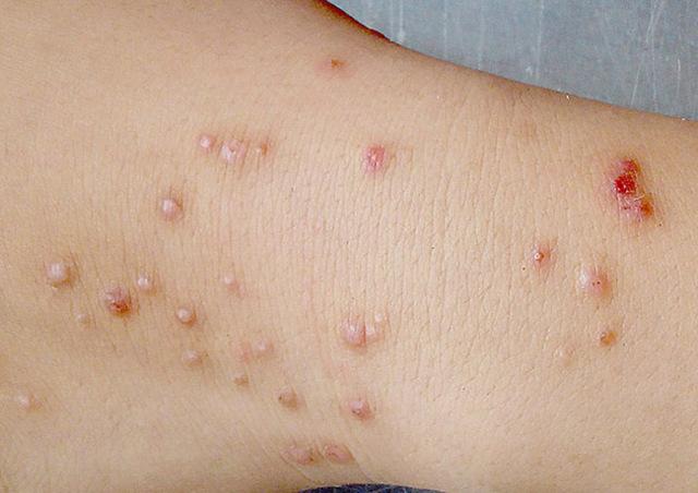 Сыпь и ранки на коже